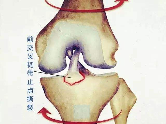 十字韧带撕裂，十字韧带撕裂能完全恢复吗!